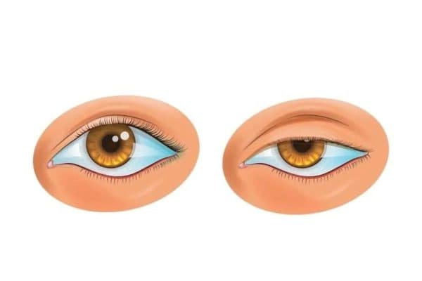 Sụp mí mắt là bệnh gì theo các bác sĩ nhãn khoa thì đây là tình trạng mí mắt trên bị chùng xuống gây cản trở thị lực