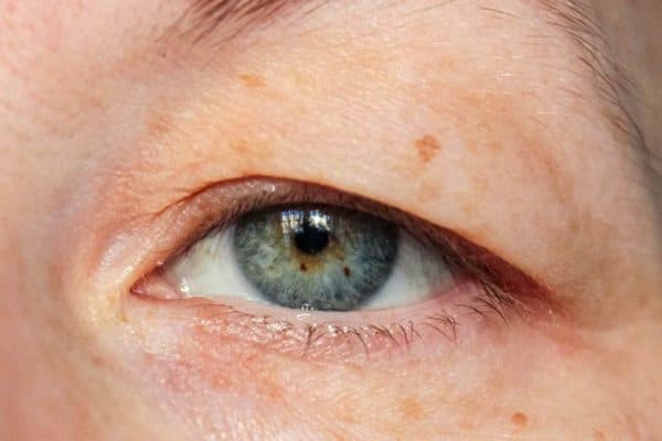 Mí sụp, chảy xệ hoặc chùng xuống ở một hoặc hai bên là dấu hiệu dễ nhận biết nhất của những người bị sụp mí