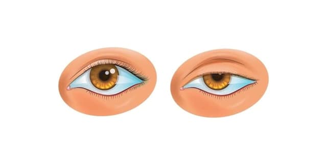Sụp mí mắt là bệnh gì, có nguy hiểm không?