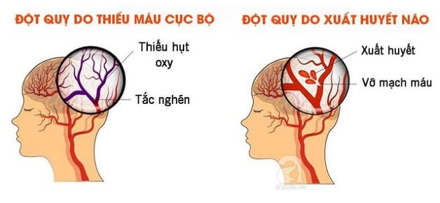 Tai biến mạch máu là gì? Phân loại 