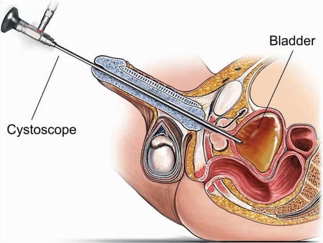 Những lưu ý trước và sau tán sỏi nội soi ngược dòng bằng laser