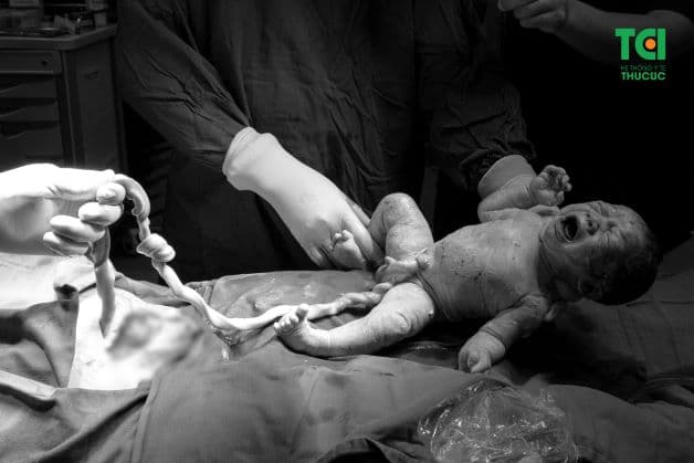 Hình ảnh thai nhi bị thắt nút dây rốn khi trào đời