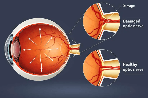 Thiên đầu thống là bệnh gì theo các bác sĩ nhãn khoa thì đây là tình trạng áp lực trong mắt tăng cao, gây tổn thương hệ thống thần kinh thị giác