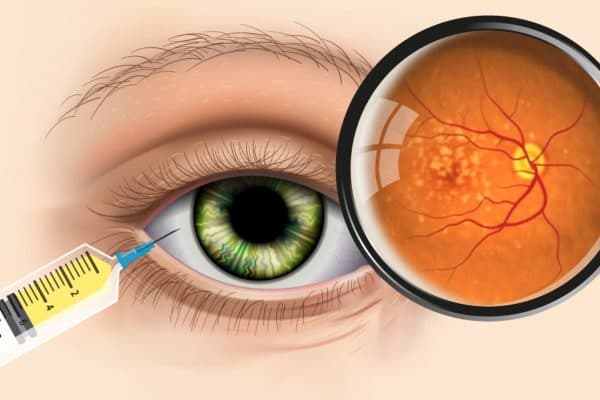 Tiêm nội nhãn điều trị thoái hóa hoàng điểm tuổi già