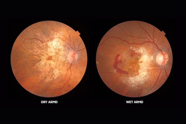 Sự khác biệt giữa thoái hóa điểm vàng thể khô và thoái hóa điểm vàng thể ướt