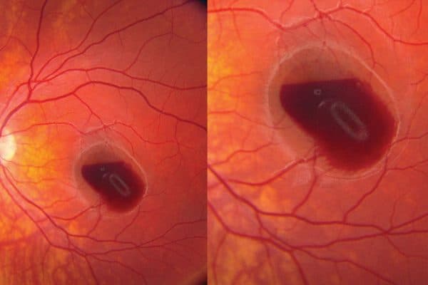Bệnh có thể dẫn tới xuất huyết võng mạc, mù lòa nếu không điều trị kịp thời