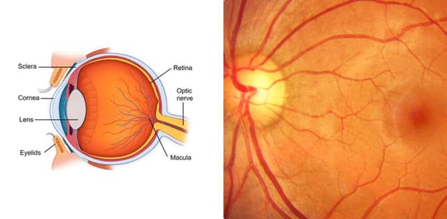 Thoái hóa võng mạc mắt là bệnh gì, điều trị như thế nào?