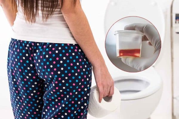 sỏi niệu đạo triệu chứng