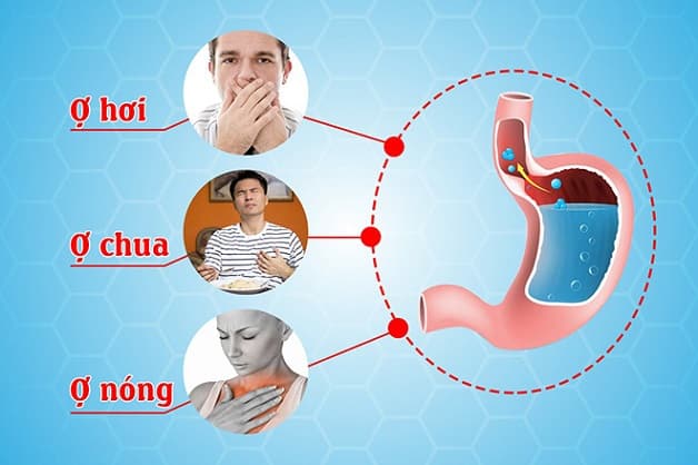 dấu hiệu dạ dày trào ngược là ợ hơi, ợ chua, ợ nóng