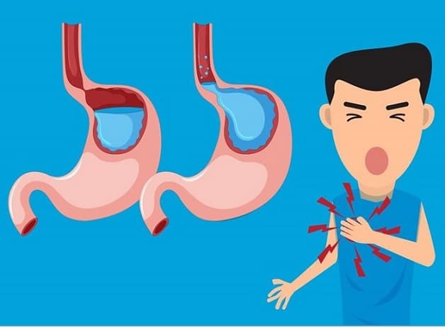 dấu hiệu dạ dày trào ngược