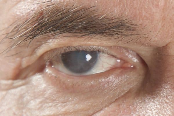 Glocom góc mở tiến triển âm thầm với các triệu chứng như nhìn mờ, thị lực suy giảm...