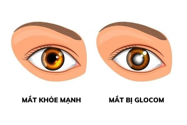Glocom là tình trạng thương tổn thị trường, lõm teo đĩa thị do tăng nhãn áp