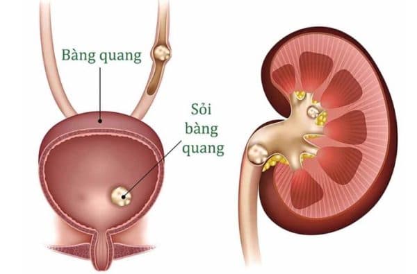 biểu hiện của sỏi bàng quang