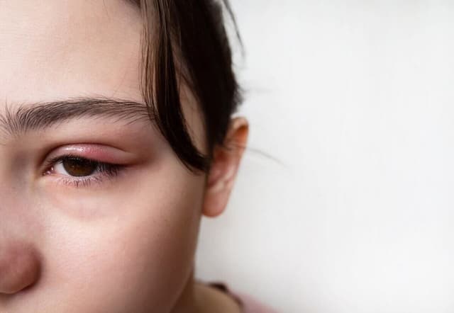 Tự dưng bị lẹo mắt? Nguyên nhân do đâu?