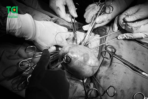 U nang buồng trứng có nguy hiểm không sẽ thể hiện qua biến chứng của từng dạng u nang