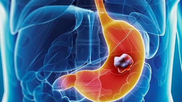 biến chứng của dị sản ruột dạ dày