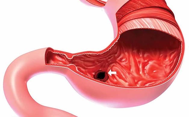 biến chứng của bệnh loét tá tràng