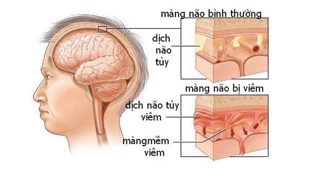 Viêm màng não mô cầu là căn bệnh nguy hiểm mà đối tượng dễ bị tấn công nhất chính là trẻ nhỏ