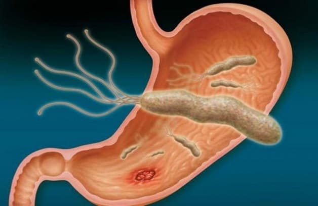 nguyên nhân của bệnh loét tá tràng