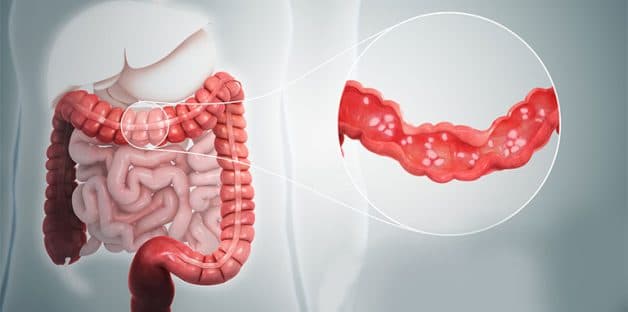 viêm loét đại tràng