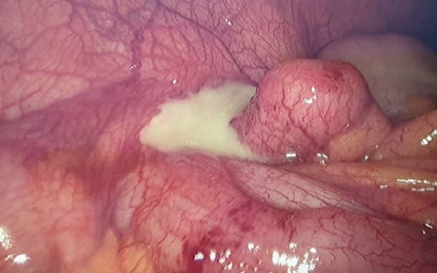 viêm phúc mạc ruột thừa là gì