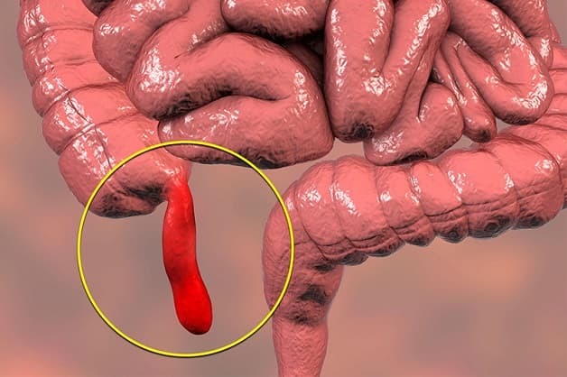 nguyên nhân gây ra bệnh viêm ruột thừa ở trẻ em