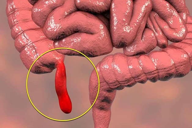 bệnh viêm ruột thừa ở trẻ em là gì