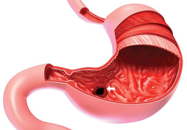 Viêm sưng huyết hang vị là bệnh lý phổ biến ở hệ tiêu hóa