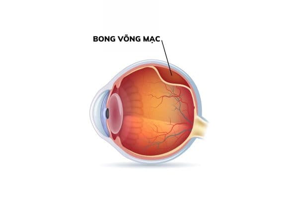 Mô võng mạc bị bong khỏi đáy mắt do chấn thương nhãn cầu đáy mắt