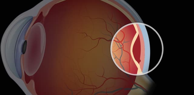 Võng mạc mắt và các bệnh lý võng mạc thường gặp