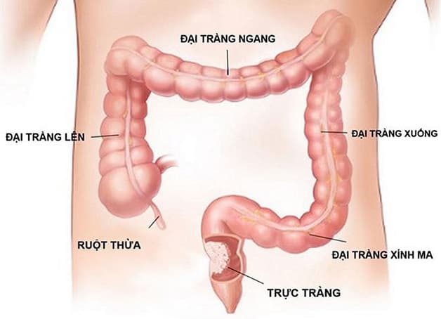 nội soi đại trang sigma