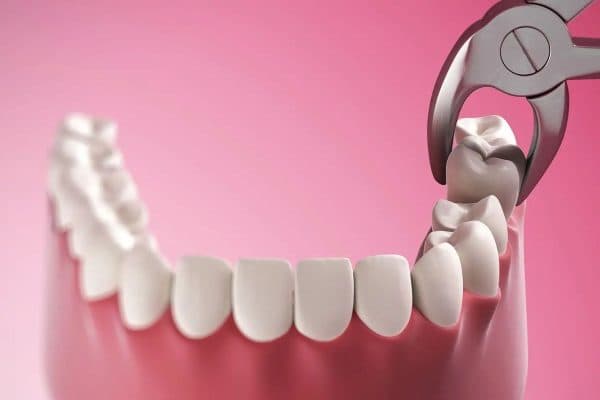 Nhổ răng khôn bằng kìm là phương pháp truyền thống thường được áp dụng hiện nay