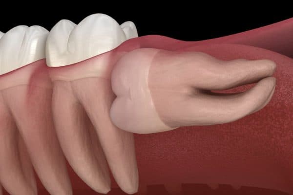 Răng khôn mọc ngang thường gây đau đớn, sưng tấy nướu khiến mọi người cảm thấy phiền toái