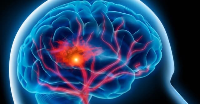 Đột quỵ và tai biến mạch máu não là một hay hai bệnh khác nhau