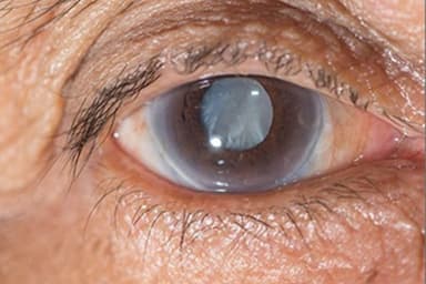 Bệnh Glocom là gì? Có điều trị được không?