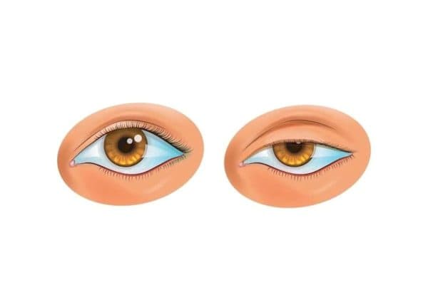 Sụp mi mắt là tình trạng sa xuống của mi mắt trên, thấp hơn so với vị trí của mí mắt khi ở trạng thái bình thường