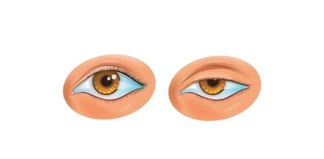 Bệnh sụp mí mắt: Nguyên nhân, dấu hiệu, cách điều trị