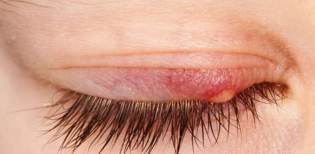 Bệnh viêm bờ mi: Dấu hiệu nhận biết và nguyên tắc điều trị