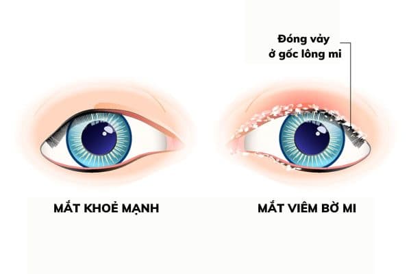 Bệnh viêm bờ mi là hiện tượng viêm nhiễm xảy ra ở biểu bì của bờ tự do mi mắt