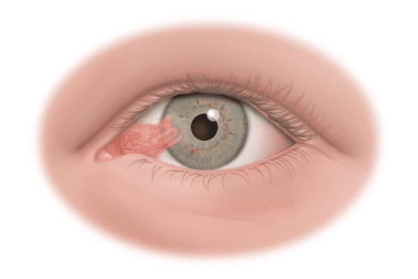 Mộng thịt là sự phát triển bất thường của các mô thịt vùng góc mắt, lan sang giác mạc