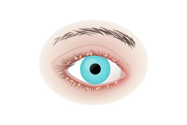 Bờ mi mắt bị các tác nhân có hại tấn công gây viêm nhiễm được gọi là viêm bờ mi