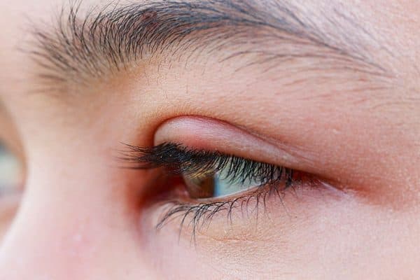 Lẹo mắt là một trong những biến chứng viêm bờ mi thường gặp nếu không được điều trị kịp thời