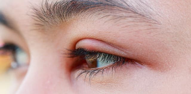 Cảnh giác với các biến chứng viêm bờ mi