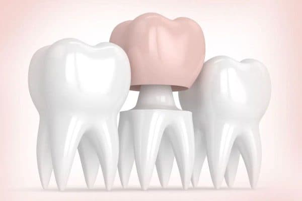 Bọc răng sứ có nhiều ưu điểm nổi trội trong việc khắc phục thẩm mỹ và chức năng răng