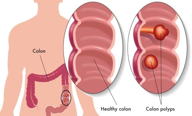 Polyp được chia làm 2 loại có cuống và không có cuống