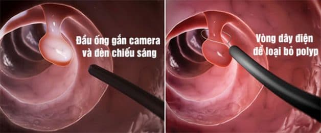 Cắt polyp đại tràng thông qua nội soi