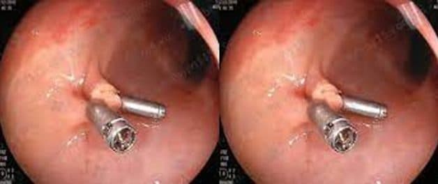 Bác sĩ thực hiện kẹp clip tại vị trí cắt để giảm thiểu tối đa nguy cơ chảy máu vị trí cắt polyp