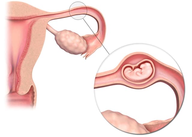 Chửa ngoài tử cung bị vỡ – Tai nạn sản khoa nguy hiểm chị em cần lưu ý