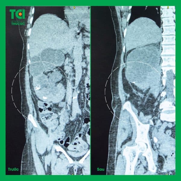 tán sỏi ngoài cơ thể có nguy hiểm không 