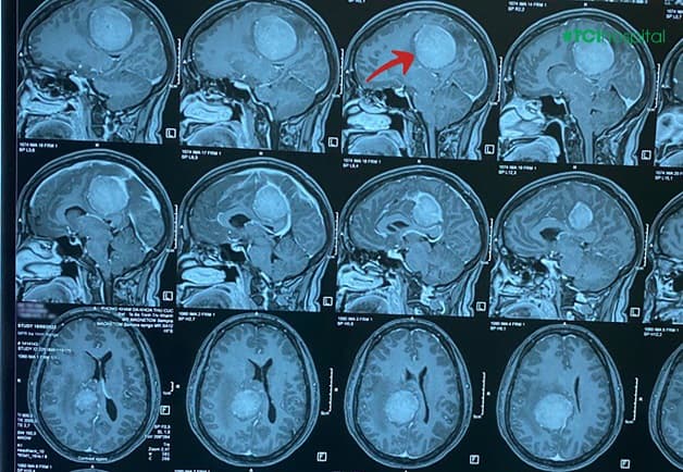 Đau đầu trong u não như có vật gì đó đè nặng